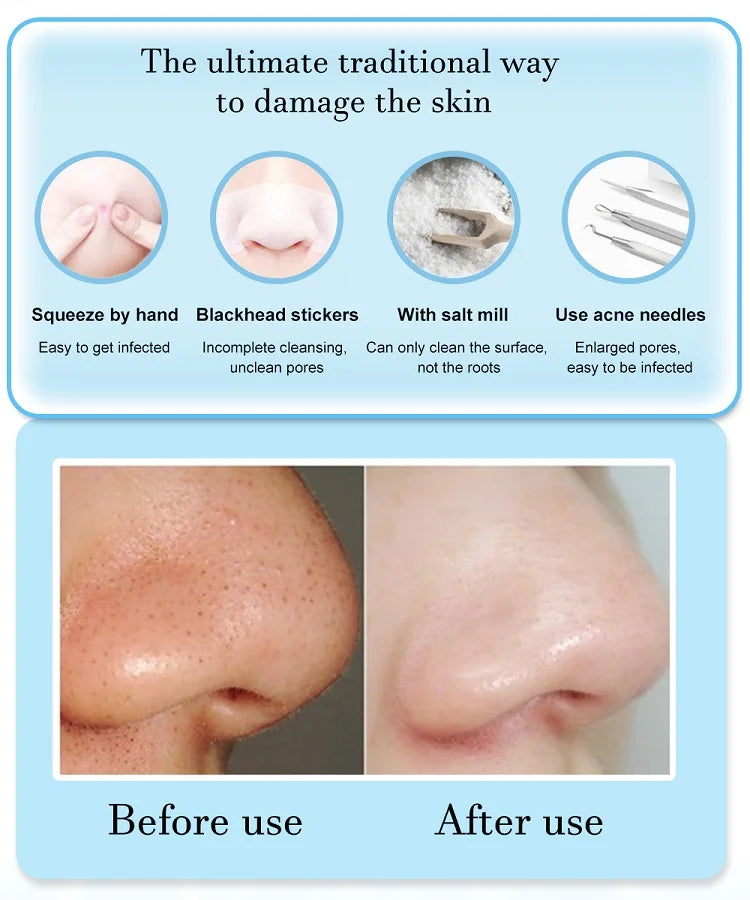 3-Mode Facial Pore Vacuum – Blackhead & Dead Skin Remover